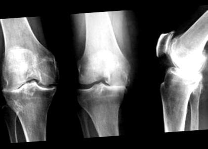 посттравматична артроза на колянната става